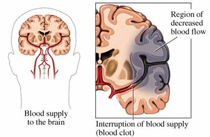 How Your Brain Heals After A Stroke